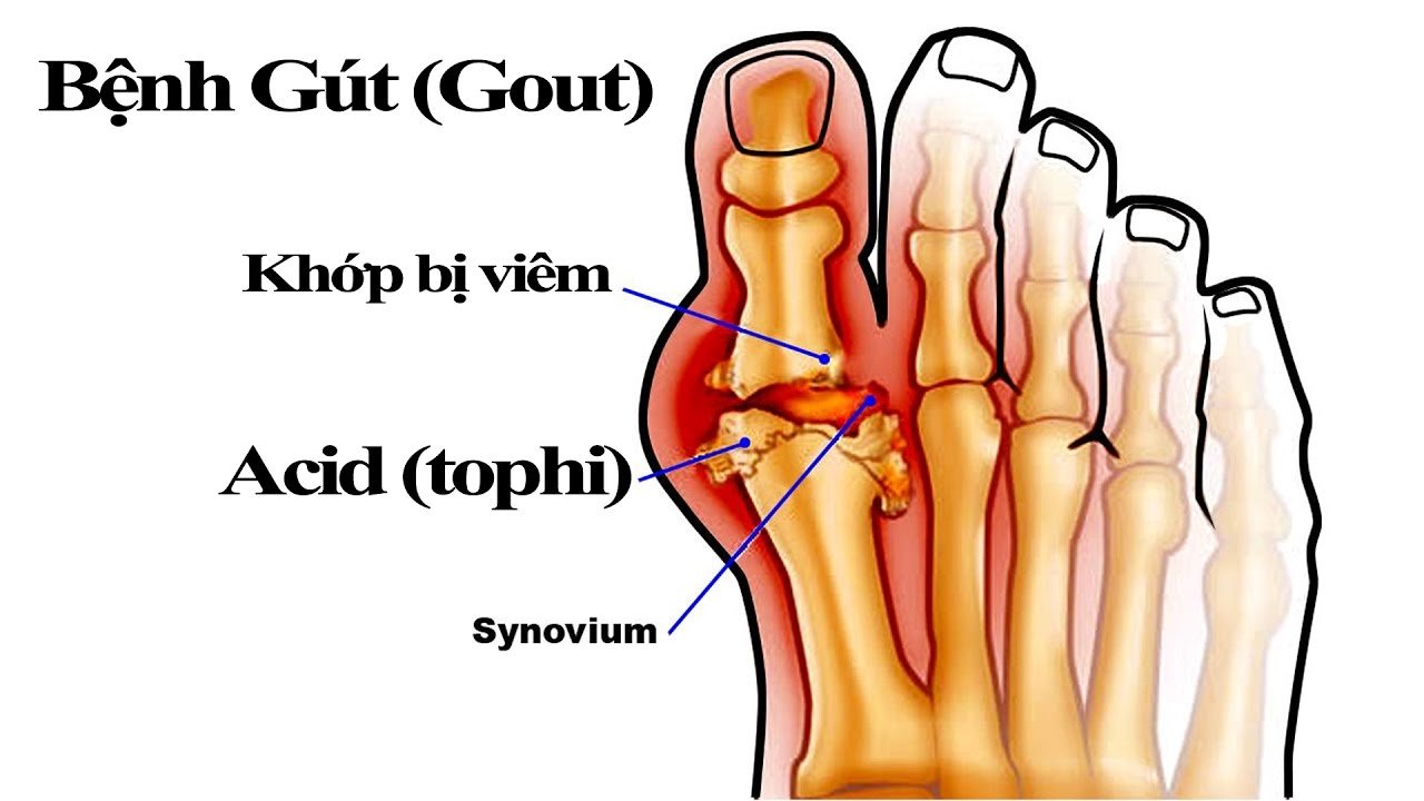 Rối loạn chuyển hóa gây đau nhức xương khớp