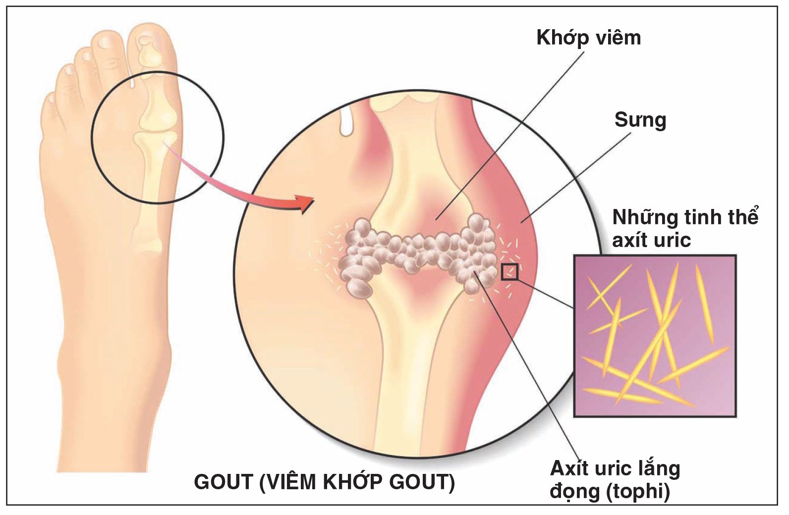 Gout là bệnh xuất hiện do sự rối loạn chuyển hóa